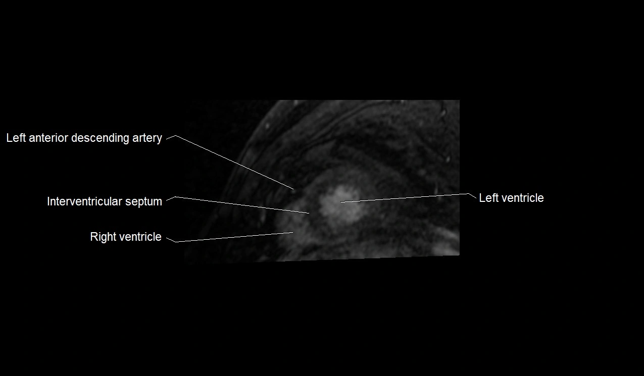 MRI heart and coronary arteries short axis anatomy image 35.webp